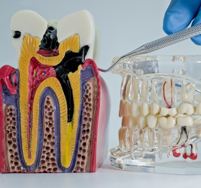 dental model depicting root canals in kansas city office