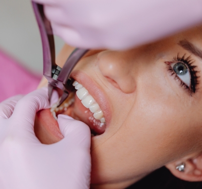 tooth extractions being performed on a patient at staley dental arts