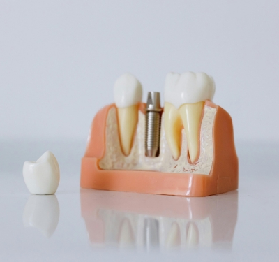 dental implant crowns in kansas city being show on a model