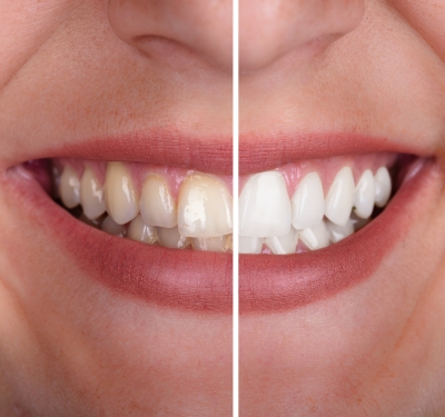 Teeth whitening in kansas city performed by staley dental arts